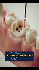 How a Root Canal Saves Your Tooth! 🦷 #shorts