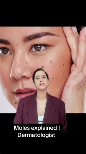#fyp #moles #nevus #melanoma #bestdermatologistkathmandu | mole