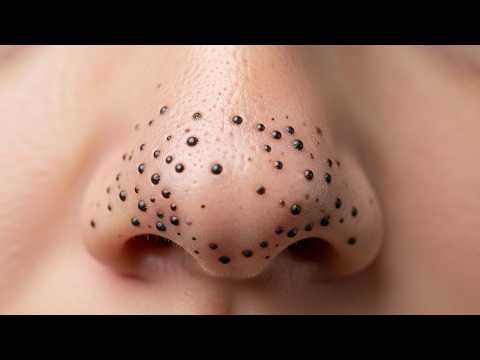 Loan Nguyen Acne Treatment 10ll