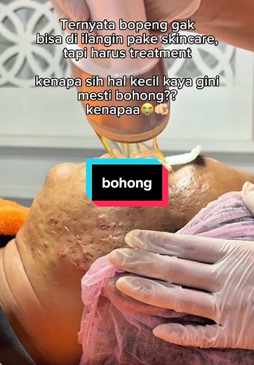 Terapi CO2 Laser untuk Bopeng Jerawat