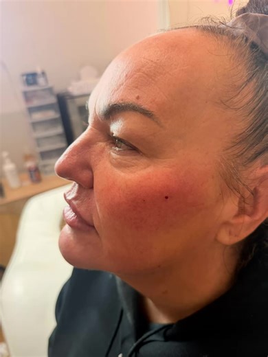 Chin and Cheek Filler: Enhance Your Contours