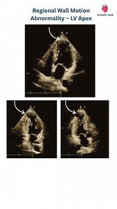 🎥 Regional Wall Motion Abnormality – LV Apex This echocardiographic video demonstrates regional wall motion abnormality involving the left ventricular apex, characterized by reduced systolic thickening and impaired inward motion of the apical segments. 👉 Clinical significance: Apical RWMA most commonly reflects ischemia or infarction in the LAD coronary artery territory. It may be seen in: Acute or chronic anterior wall myocardial infarction Stress (Takotsubo) cardiomyopathy – apical balloonin