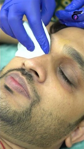 Chemical Peeling Procedure Step by Step 🔥 | What Really Happens to Your Skin? #chemicalpeel #shorts