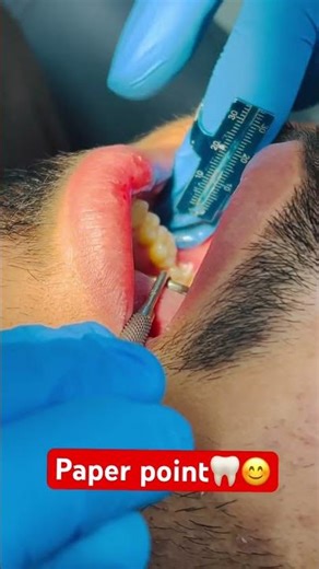 Dental paper point🦷🦷😉😉 #youtubeshorts 🦷🦷🙈🙈🙈