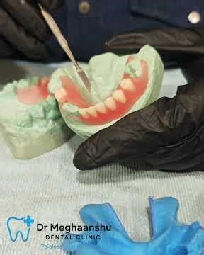 Upper Fixed Bridge & Lower Flipper Denture | Complex Flexible Partial Denture Case | Antony Smith