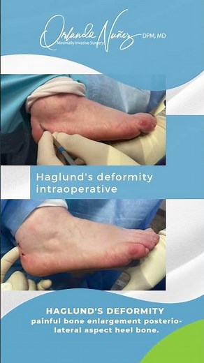 Haglund's deformity correction with Minimally Invasive Surgery