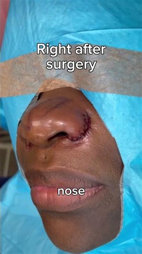 What Nose Job to Get if You're Ethnic? - Dr. Tanveer Janjua