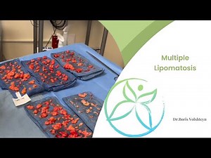 Multiple Lipomatosis - Dr. Boris Volshteyn