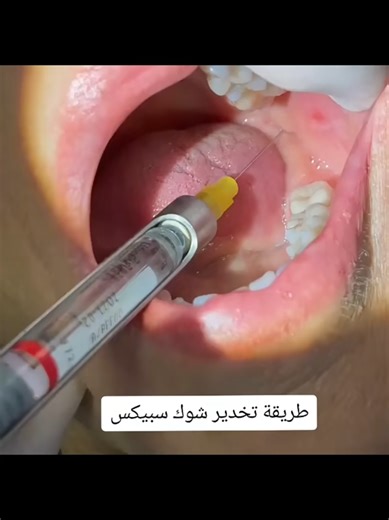 Inferior Alveolar Nerve Block in Dental Practice