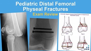 62 reactions · 19 shares | Distal femoral physeal fractures are often...