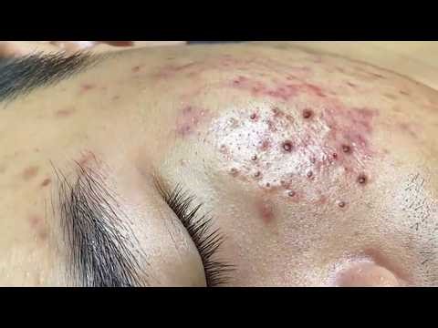 Top 3 Acne Treatment Trends You Can't Ignore in 2026