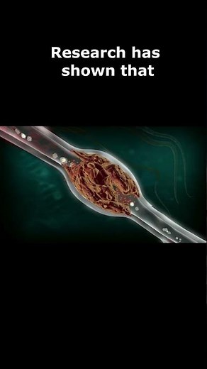 What's the treatment for Stargardt disease ?