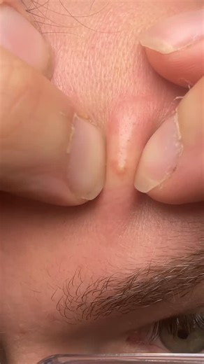 CrazyAZDeals | Viral Products & Deals | POV: You finally try that healing patch everyone talks about 😱 Get yours below 👇 👉 Get yours from 👉 Follow me and comment PIMPLE to get... | Instagram