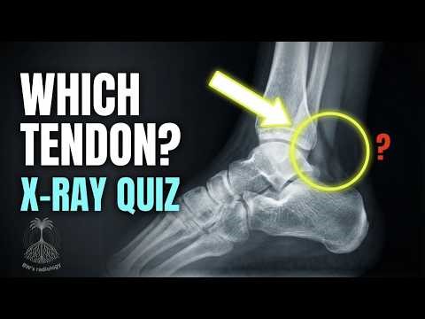 Lateral Ankle X-ray: Why This Shadow Is Flexor Hallucis Longus