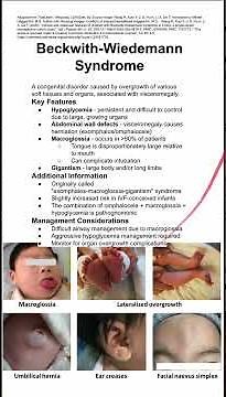 Beckwith-Wiedemann Syndrome