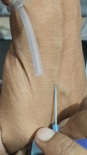 Iv cannulation technique #doctor #hospital #trustonallah #trending #shorts #shortsfeed#viral#nursing