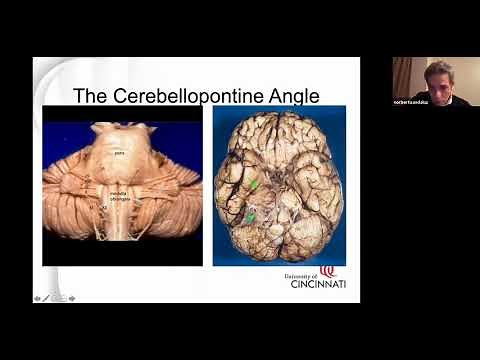 The Retrosigmoid Surgical Approach to Treat Acoustic Neuromas