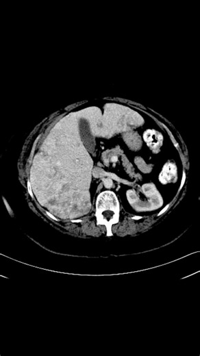 Hepatic Epithelioid Hemangioendothelioma #shorts