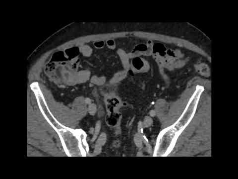 Retrocaval ureter on CT imaging