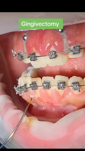 Traitement de l'hyperplasie gingivale : Gingivectomie expliquée