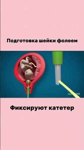 Как готовят шейку матки катетером фолея показано на видео😍 #акушергинеколог #подготовкакродам