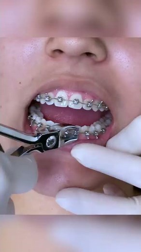 Satisfying Braces Removal w/ The Braces Doc (ASMR) — How we remove braces