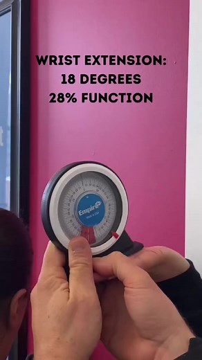When one of our own employees came in talking about hand tingling and tension, we thought it would be a great idea to show you how to fix the problem.The first thing we do is measure how much function her forearm muscles/wrist has to get a baseline. Then we palpate to find out if there is adhesion that needs fixing. (There was a lot!)Then we treat the adhesion using our hands, a hand tool, or shockwave therapy. Then we re-test to see how much improvement our treatment got us. This approach allow