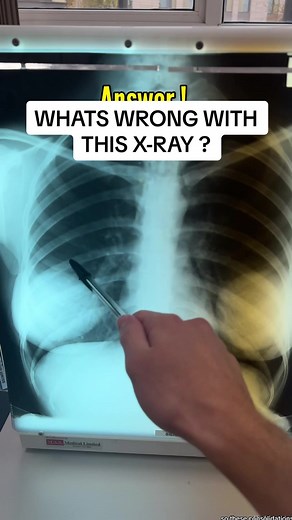 Understanding Chest X-Ray: What to Look for