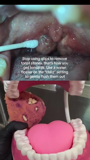 Get Rid of Tonsil Stones with a Water Flosser | Tips & Tricks