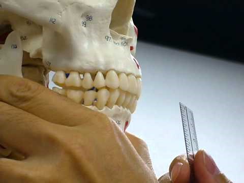 Overbite measurement