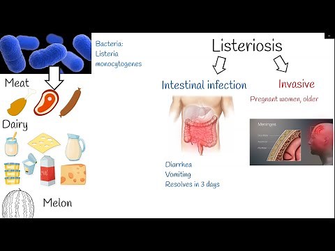 listeriosis - Symptoms and treatment. Listeria monocytogenes.