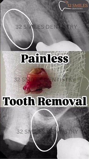 No Pain, All Gain! 🦷 Quick Tooth Removal!