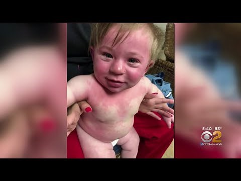 Child Has Anaphylactic Reaction To Paint With Dairy-Based Ingredients