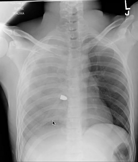 Dr Sam Ghali breaks down a chest X-ray of a shooting victim explaining the resulting hemothorax | High Performance EMS
