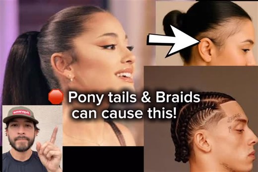 The Barber’s Cut on Instagram: "Pony Tails & Braids can cause this! Yes, it’s called Traction Alopecia. Tight Hairstyles like ponytails and braids can cause prolonged, repetitive tension on the hair follicles. Resulting in hair loss! Symptoms include a receding hairline, redness, pain, bumps, and broken hairs. Send this to someone that needs this info !! #barber #hair #hairloss #braids #ponytail"