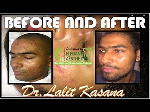 BEFORE AND AFTER SEVERE ACNE BY DR.LALIT KASANA