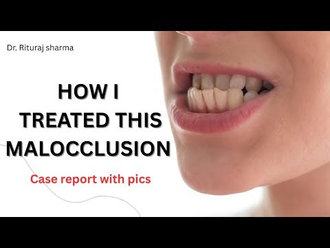 Treatment of opposite bite (reverse overjet ) class- ||| malocclusion @Braces_dentist