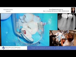 LiveEndo: #30 Cracked Tooth RCT