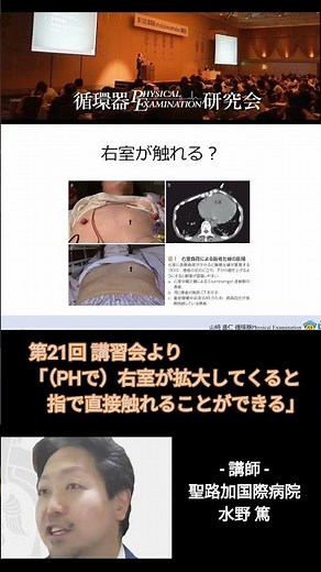 2024 No. 53 肺高血圧で右室が拡大すると触知できる