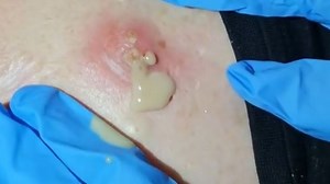 Never Seen Such a Horrible Abscess