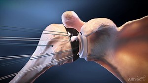 Univers Apex OptiFit™ Surgical Technique