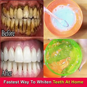 Fastest Way To Whiten Teeth At Home Post beauty tips. | Post Beauty Tips