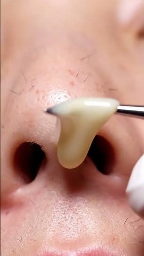 🔍 Watch This Eyebrow Blackhead Slide Out!