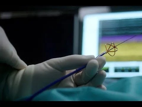 FARAPULSE™ Wave Series: Episode 5 - Promising Future with Pulsed Field Ablation