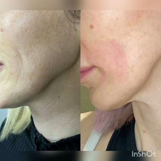 Jato de Plasma - fotos antes e depois