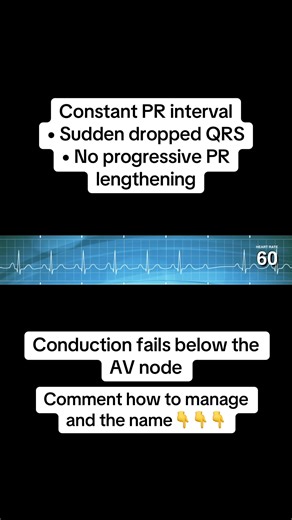 This rhythm is Second-Degree AV Block Type II (Mobitz II) 🫀 How to recognize it FAST: • PR interval stays the same • Sudden dropped QRS complexes • No warning before the pause Key concept: The atrial impulse fires normally — but conduction fails in the His-Purkinje system. Why Mobitz II matters: • Unpredictable conduction • Can progress to complete heart block • Often associated with structural heart disease Clinical thinking: ✔️ Assess perfusion and symptoms ✔️ Monitor closely ✔️ Escalation is