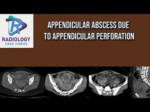 Appendicular abscess due to Appendicular perforation
