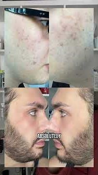 Best Acne Products Of 2025 As A Dermatology Nurse