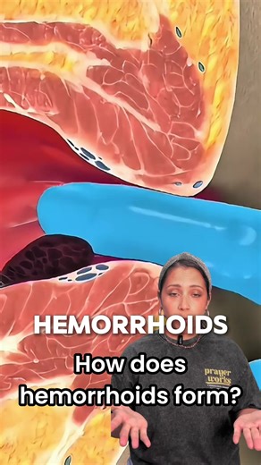 Did you know hemorrhoids actually form from inflammation? 😣 When the veins around your rectum or anus swell from pressure — like sitting too long or straining — they become irritated and painful. Instead of masking the pain with messy creams, try HemHero. It helps your body fight the inflammation from the inside out — naturally. No creams. No surgery. Just real relief.