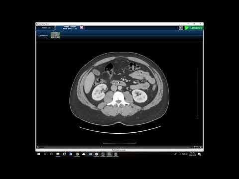 Gross Anatomy - Cross Sections of the Abdomen and Pelvis - Part 3, Axial Cuts
